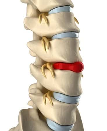 Discopatia vertebrale