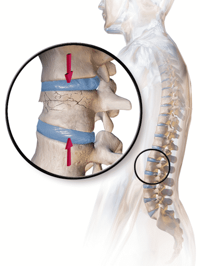 Fratture vertebrali