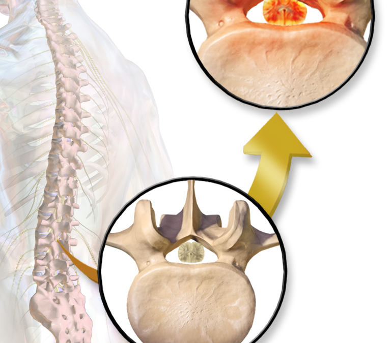 Stenosi del canale vertebrale