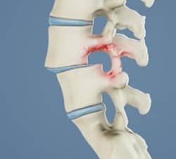 spondilolistesi degenerative e congenite